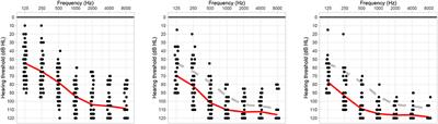 Cochlear Implant Electrode Impedance as Potential Biomarker for Residual Hearing